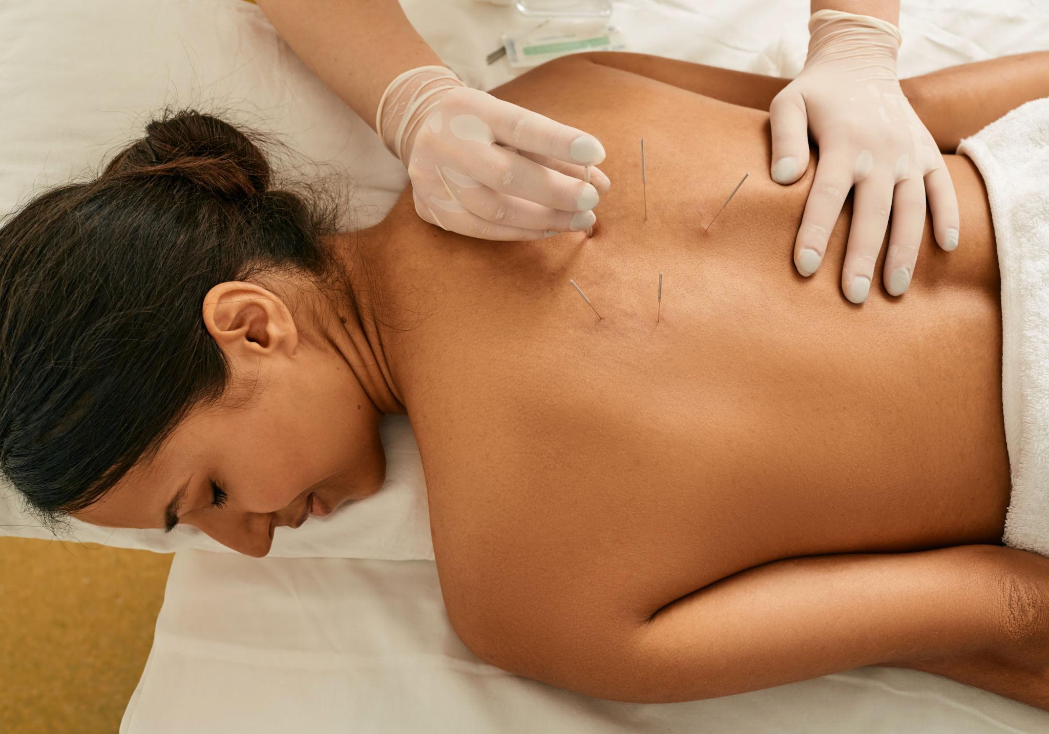 Acupunctuur
